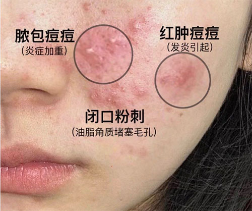導致肌膚長痘的原因有哪些？